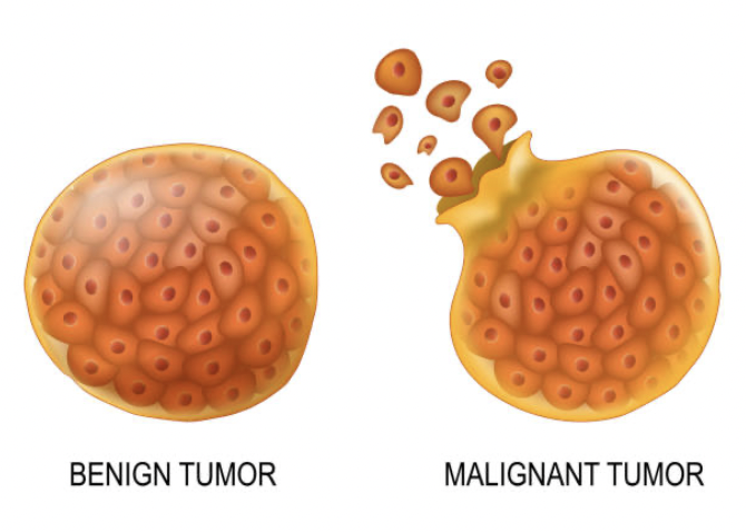 Co je benigní nádor ?
